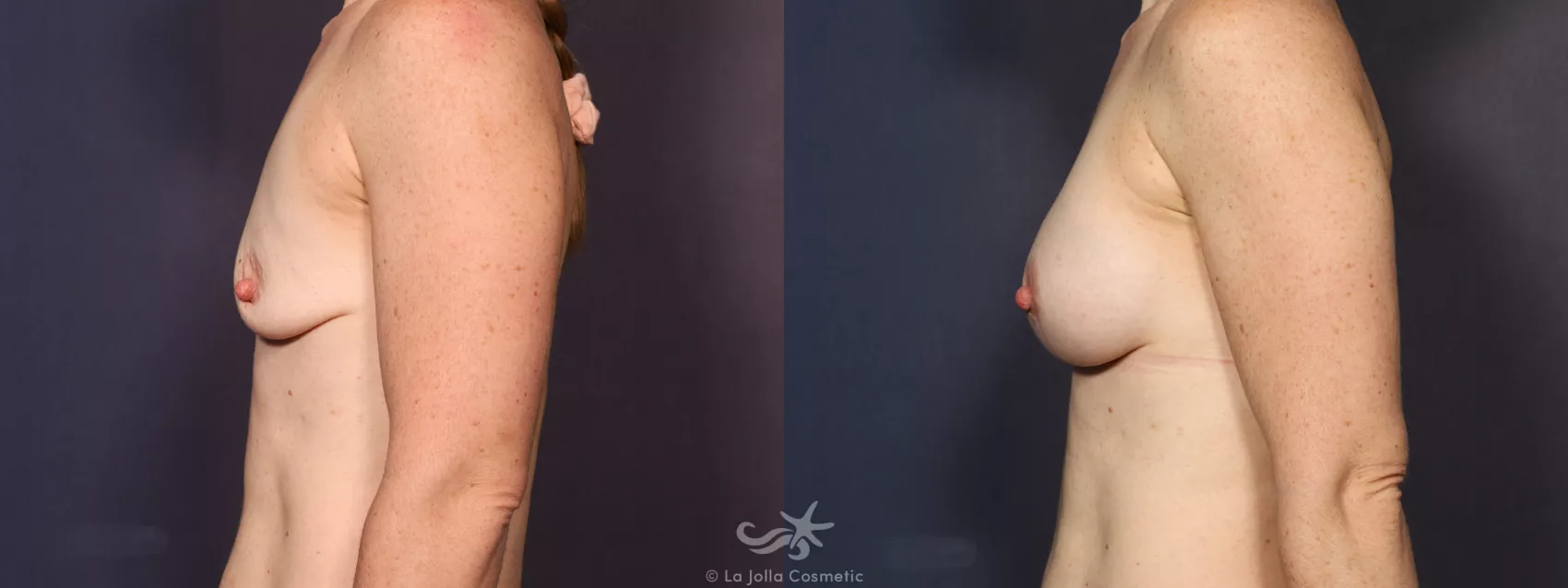 Before & After Breast Augmentation Result 727 Left Side View in San Diego, CA