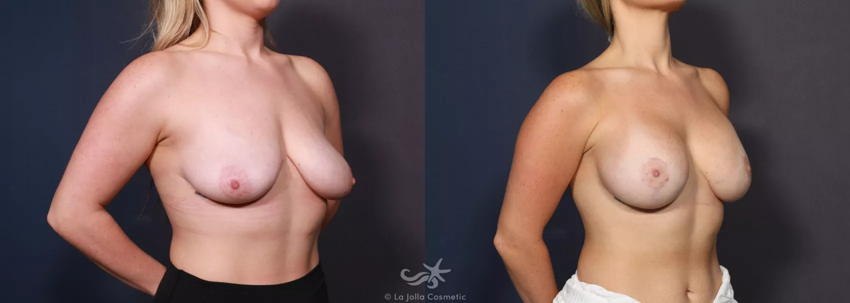 Before & After Breast Augmentation Result 739 Right Oblique View in San Diego, CA
