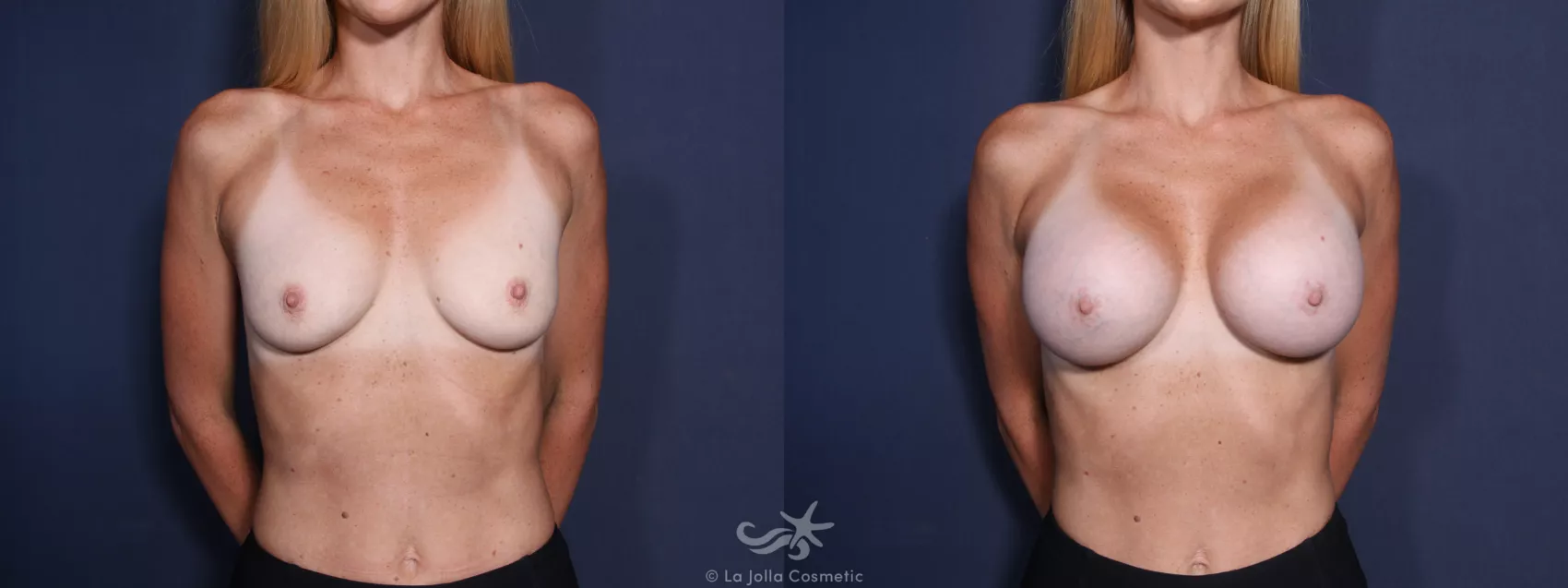 Before & After Breast Augmentation Result 74 Front View in San Diego, CA