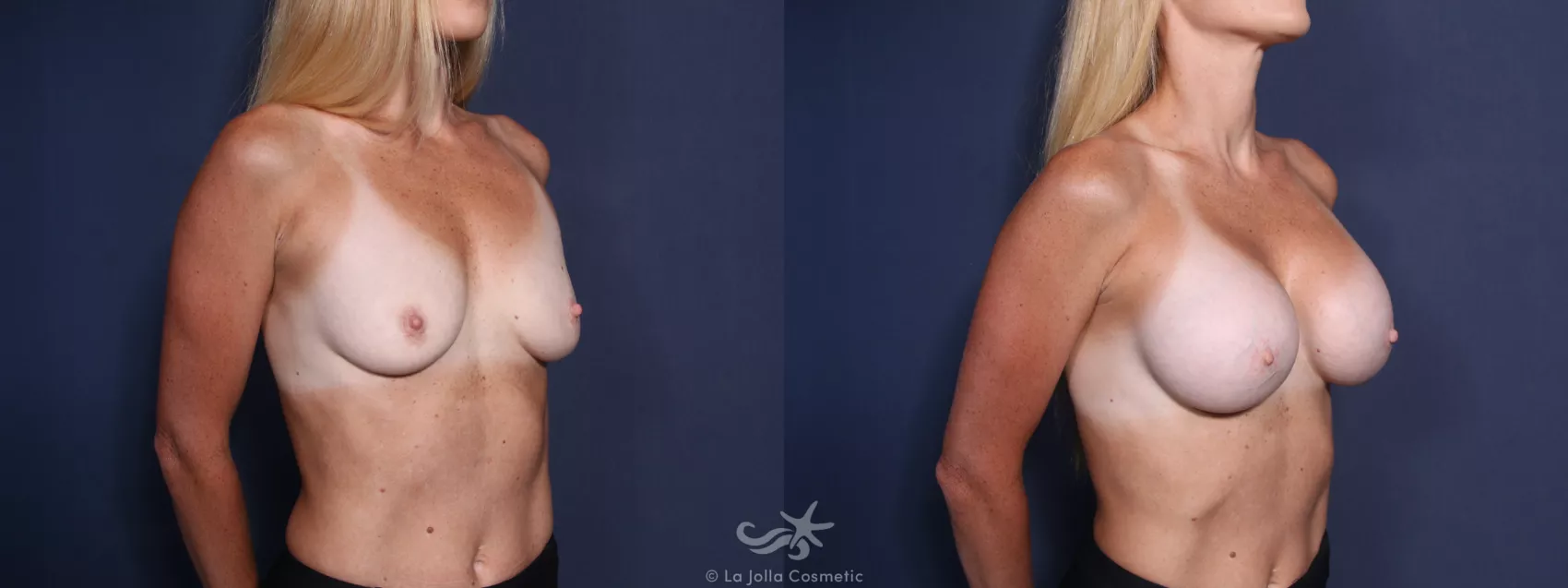 Before & After Breast Augmentation Result 74 Right Oblique View in San Diego, CA
