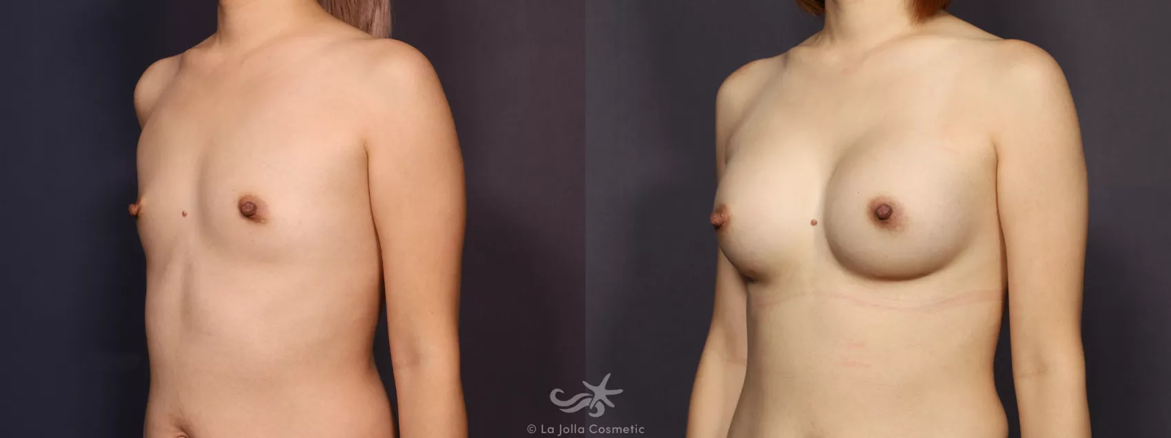 Before & After Breast Augmentation Result 746 Left Oblique View in San Diego, CA