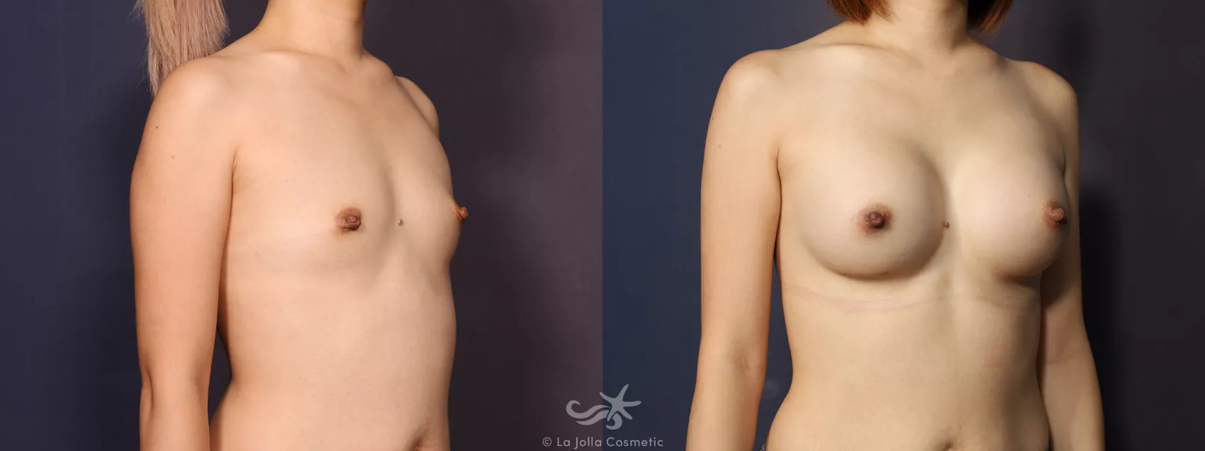 Before & After Breast Augmentation Result 746 Right Oblique View in San Diego, CA
