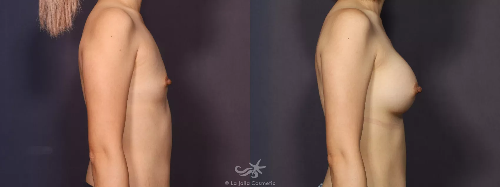 Before & After Breast Augmentation Result 746 Right Side View in San Diego, CA