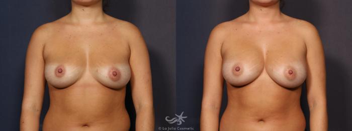 Before & After Breast Augmentation Result 752 Front View in San Diego, Carlsbad, CA