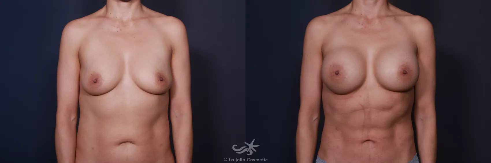Before & After Breast Augmentation Result 78 Front View in San Diego, CA