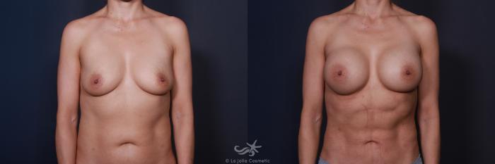 Before & After Breast Augmentation Result 78 Front View in San Diego, Carlsbad, CA