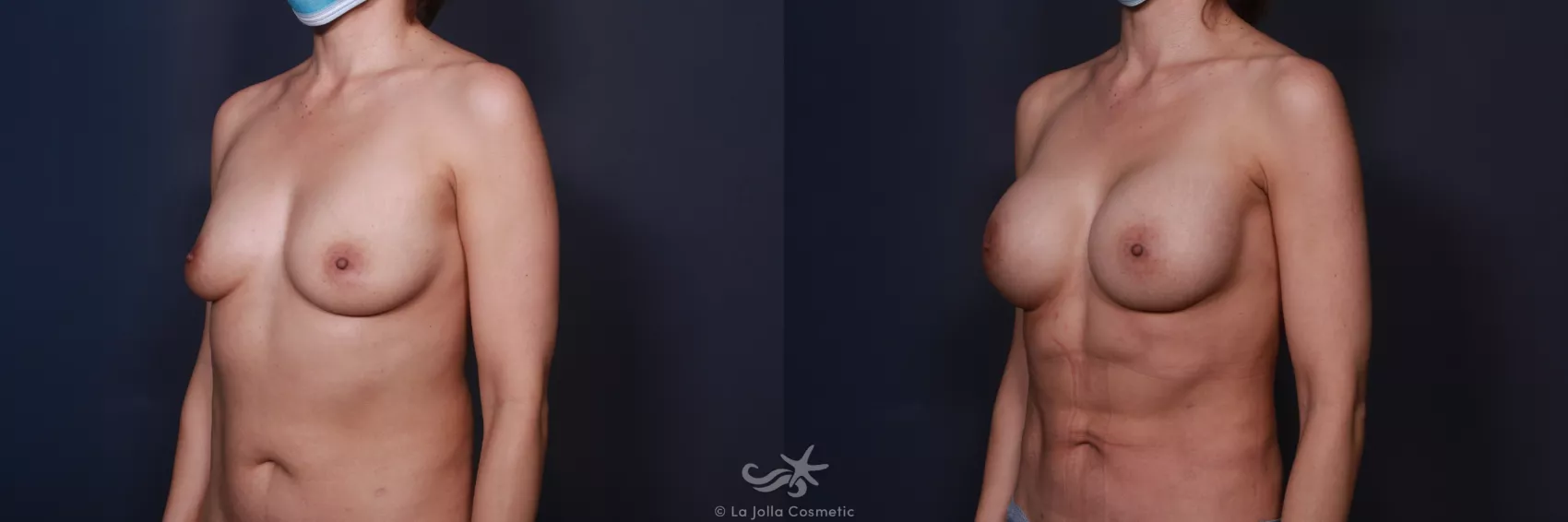 Before & After Breast Augmentation Result 78 Left Oblique View in San Diego, CA