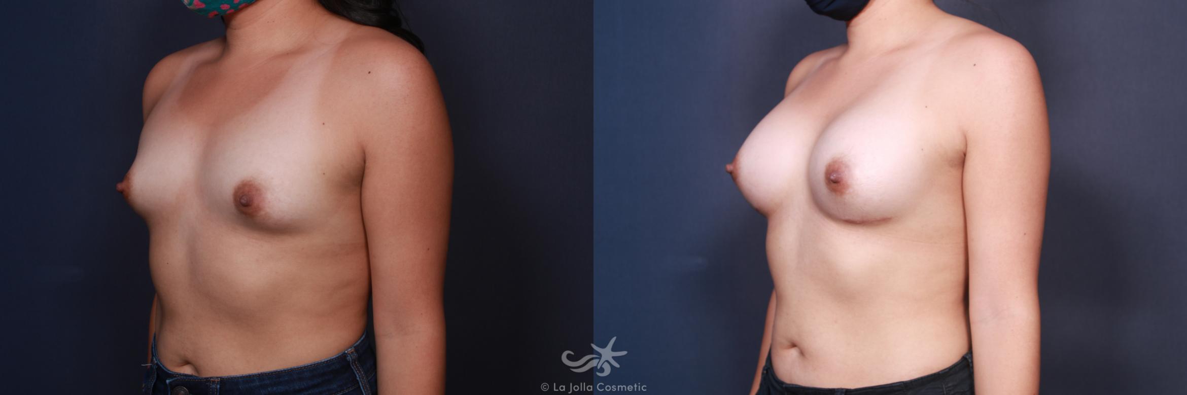 Before & After Breast Augmentation Result 83 Left Oblique View in San Diego, CA