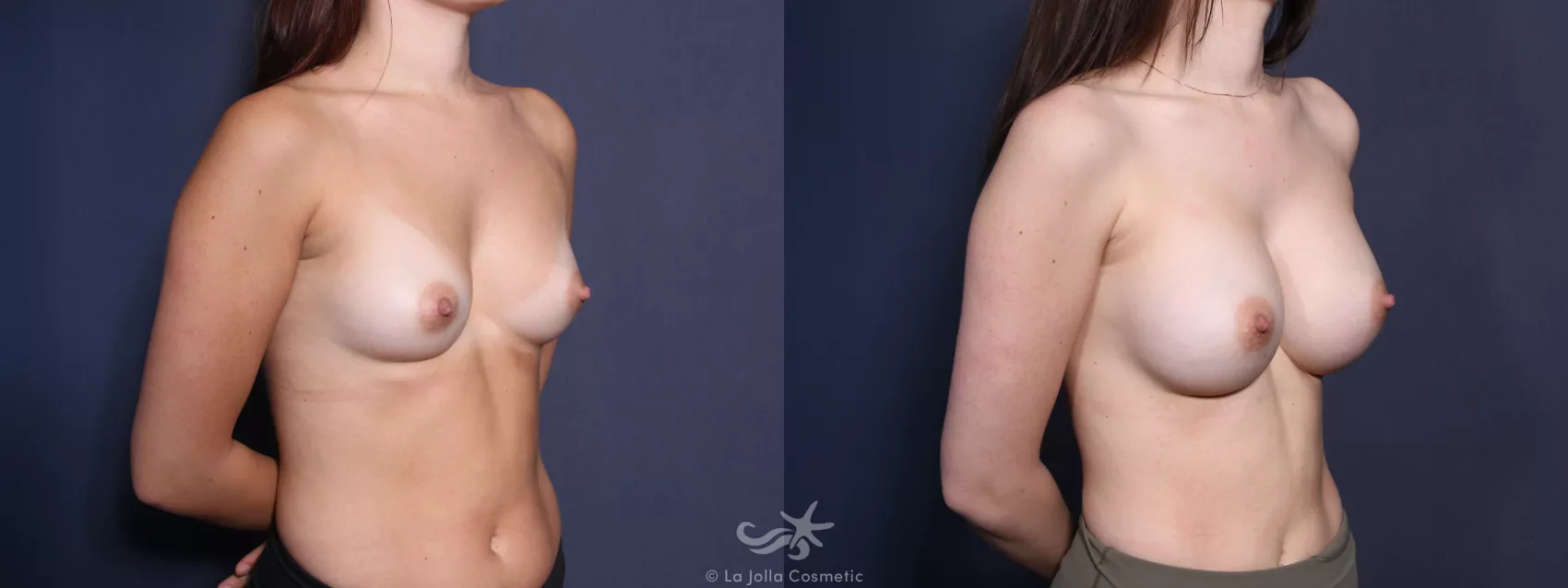 Before & After Breast Augmentation Result 84 Right Oblique View in San Diego, CA