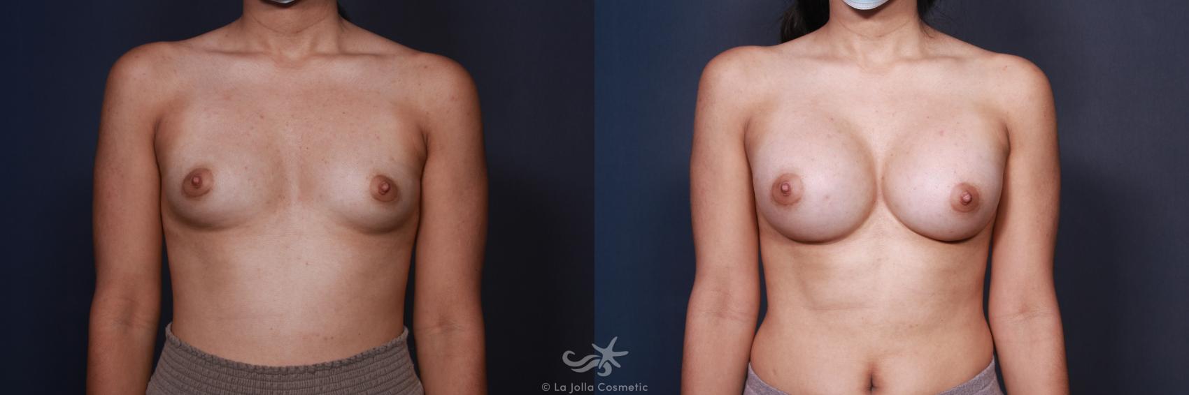 Before & After Breast Augmentation Result 86 Front View in San Diego, CA