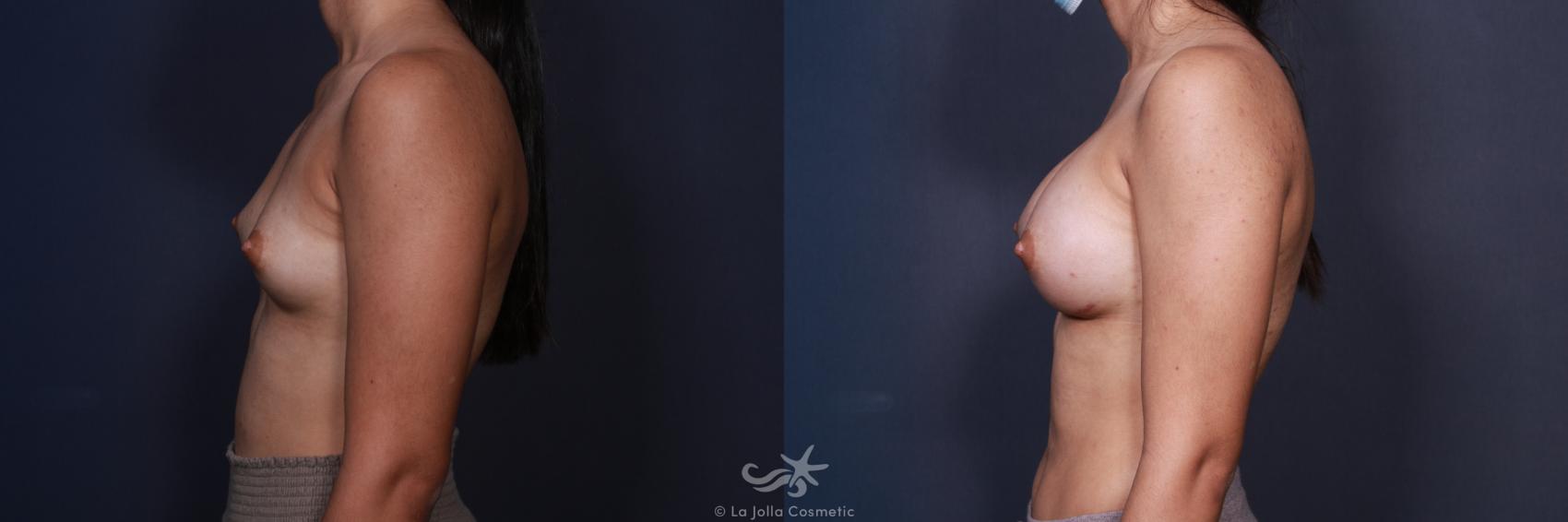Before & After Breast Augmentation Result 86 Left Side View in San Diego, CA
