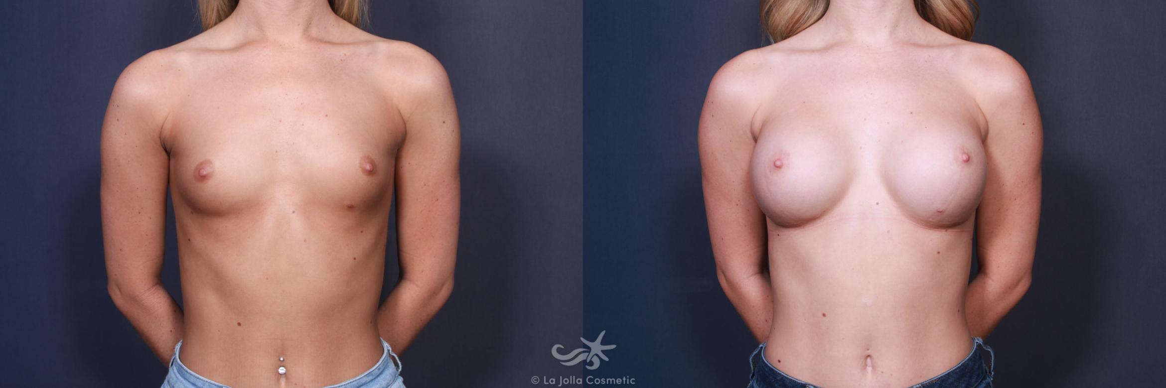 Before & After Breast Augmentation Result 87 Front View in San Diego, CA