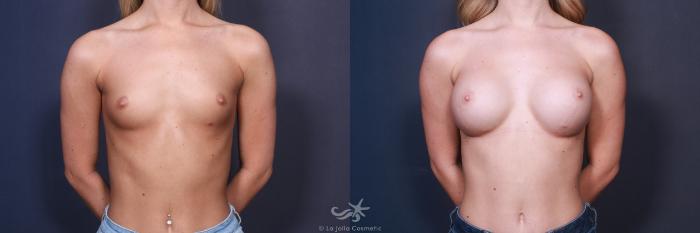 Before & After Breast Augmentation Result 87 Front View in San Diego, Carlsbad, CA