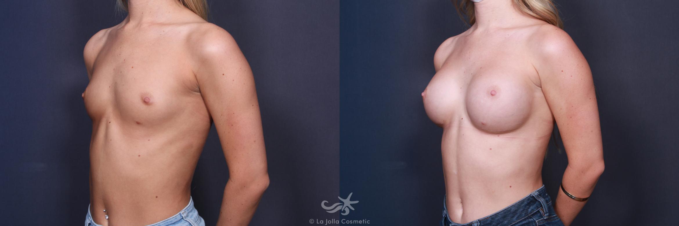 Before & After Breast Augmentation Result 87 Left Oblique View in San Diego, CA