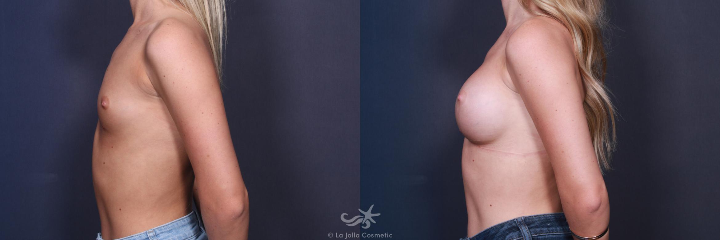 Before & After Breast Augmentation Result 87 Left Side View in San Diego, CA