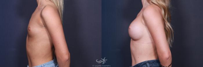 Before & After Breast Augmentation Result 87 Left Side View in San Diego, Carlsbad, CA