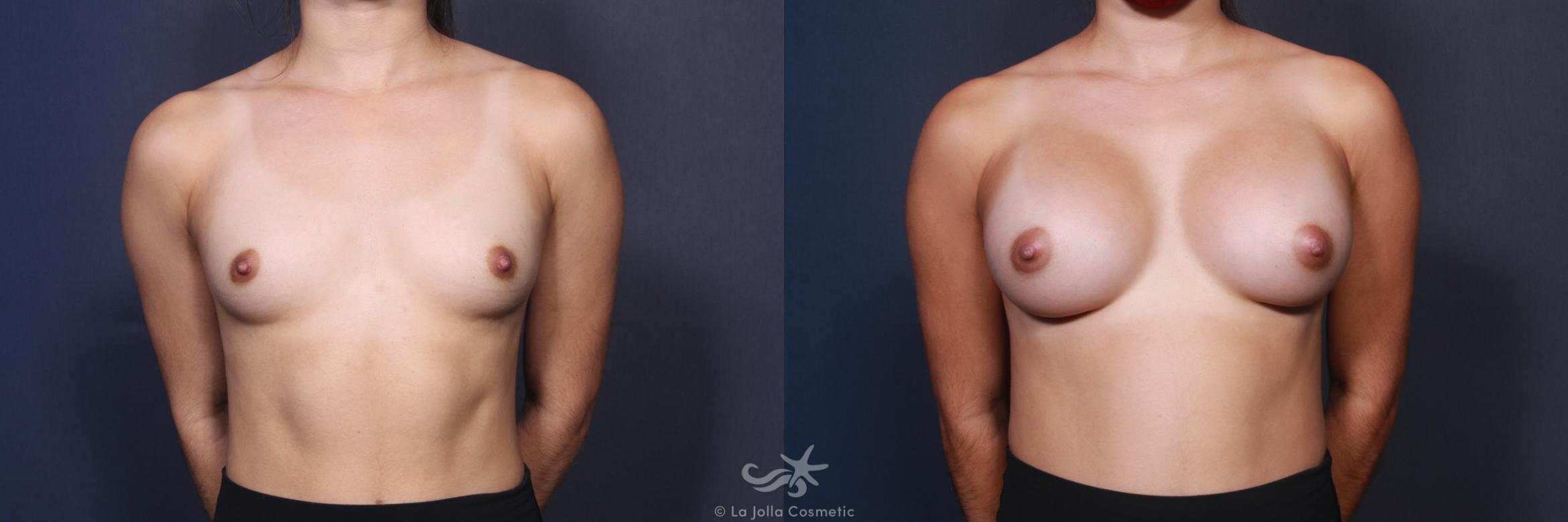Before & After Breast Augmentation Result 88 Front View in San Diego, CA