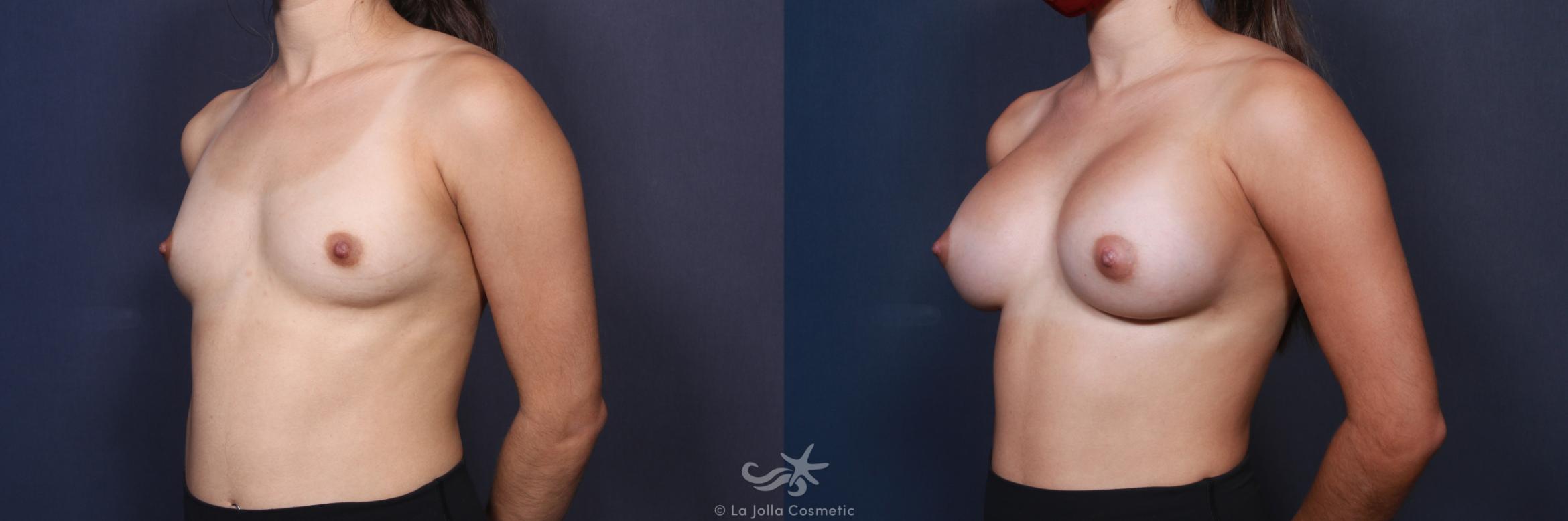 Before & After Breast Augmentation Result 88 Left Oblique View in San Diego, CA