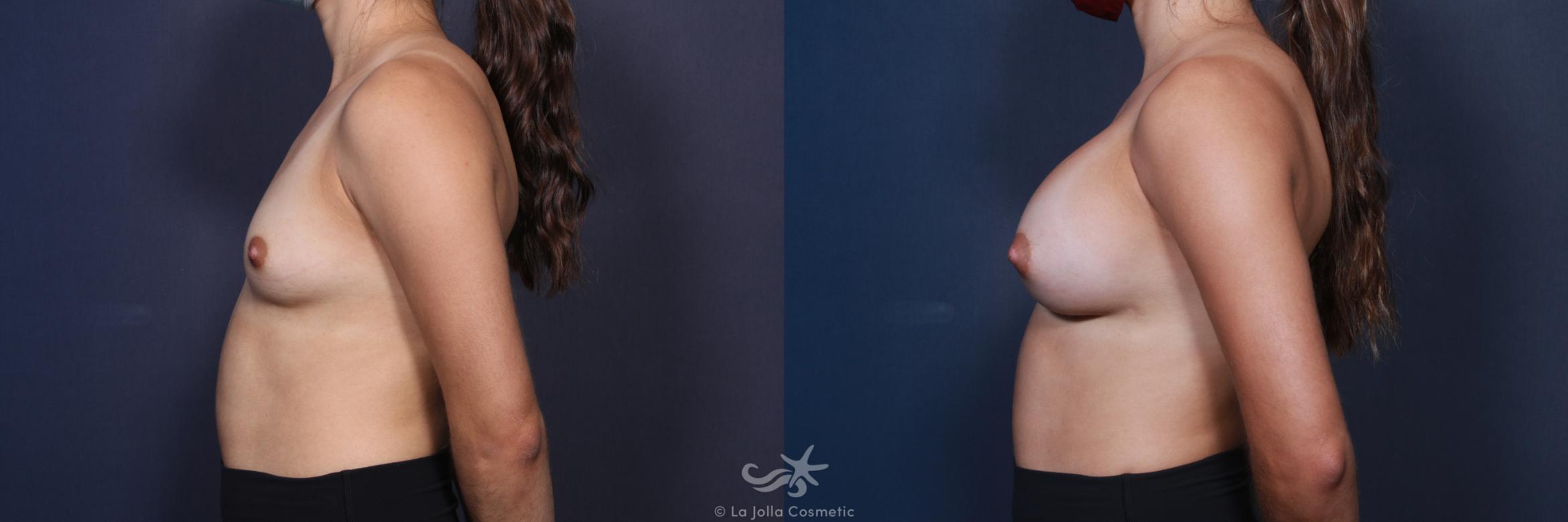 Before & After Breast Augmentation Result 88 Left Side View in San Diego, CA