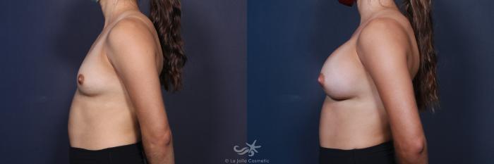 Before & After Breast Augmentation Result 88 Left Side View in San Diego, Carlsbad, CA