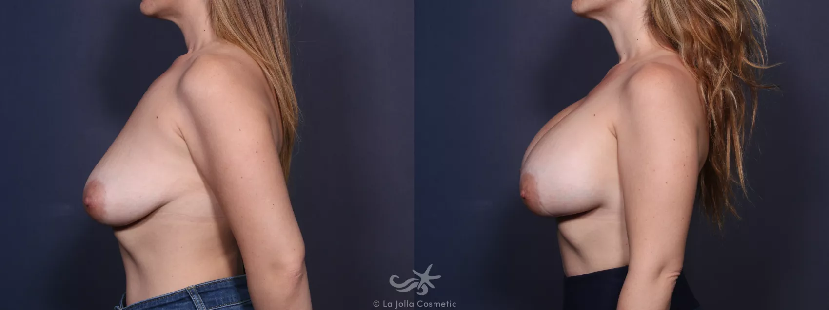 Before & After Breast Augmentation Result 93 Left Side View in San Diego, CA