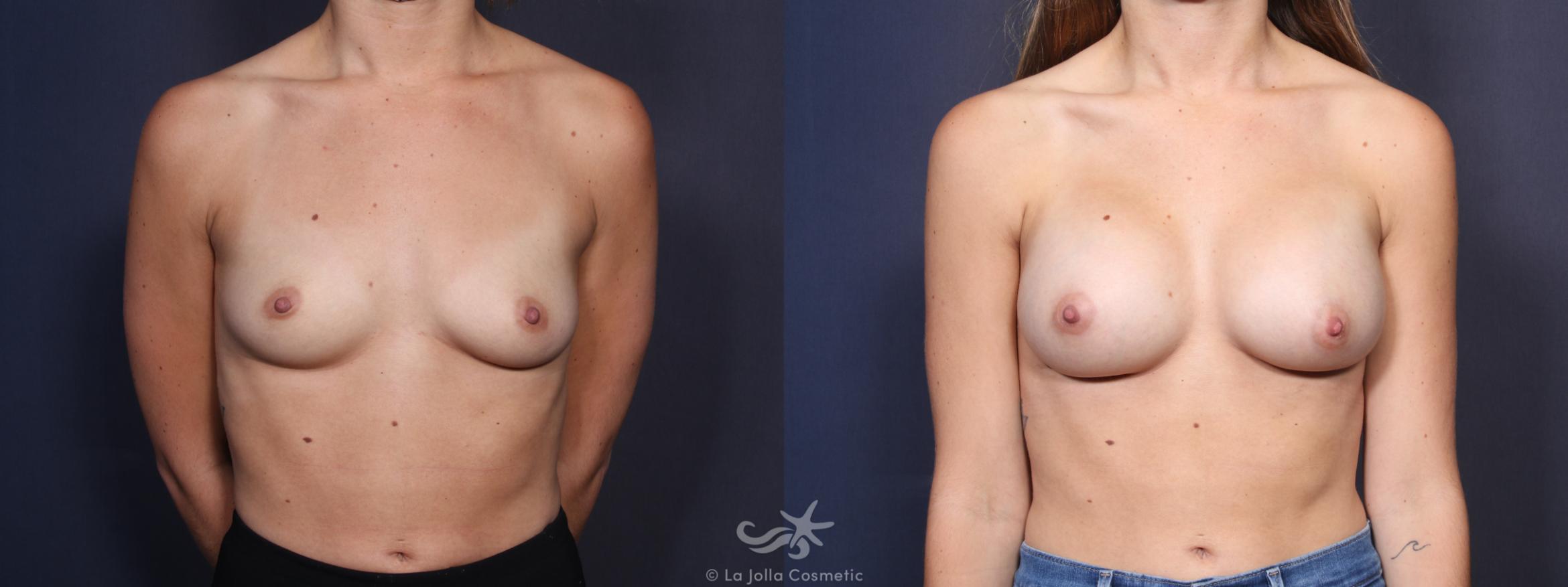 Before & After Breast Augmentation Result 94 Front View in San Diego, CA