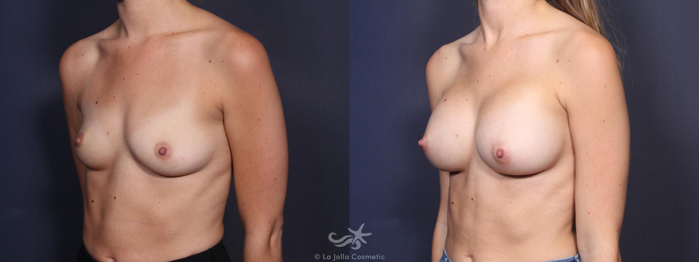Before & After Breast Augmentation Result 94 Left Oblique View in San Diego, CA