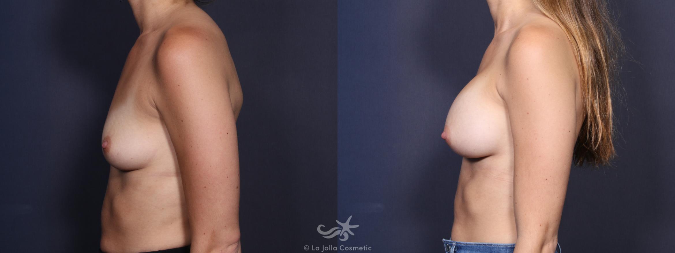 Before & After Breast Augmentation Result 94 Left Side View in San Diego, CA
