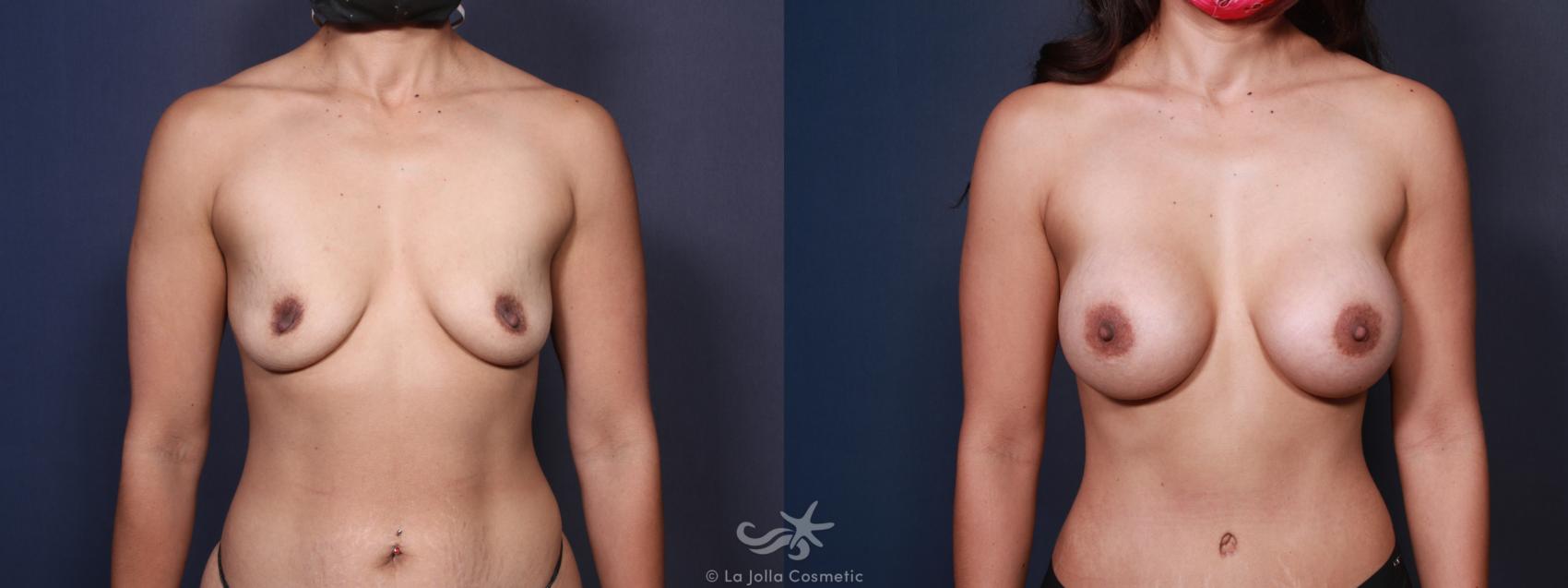 Before & After Breast Augmentation Result 96 Front View in San Diego, CA