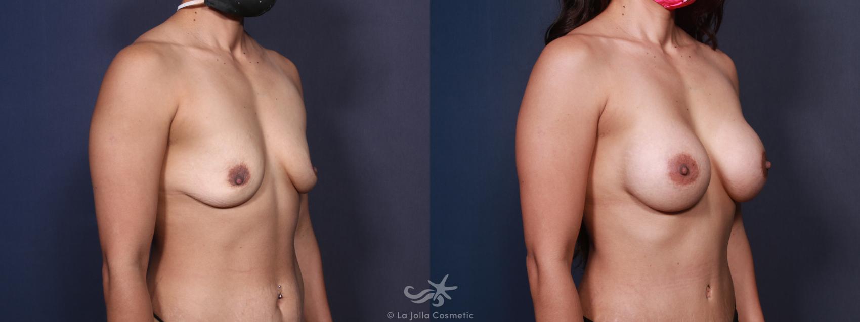 Before & After Breast Augmentation Result 96 Right Oblique View in San Diego, CA