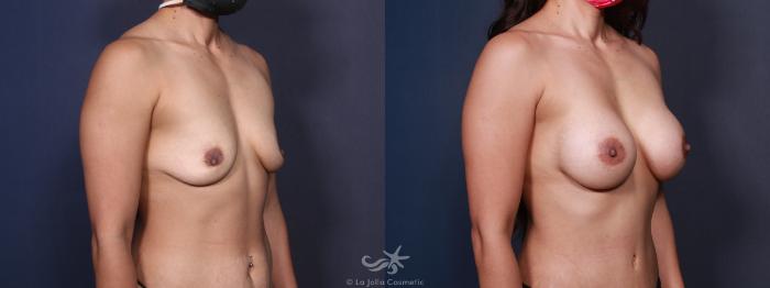 Before & After Breast Augmentation Result 96 Right Oblique View in San Diego, Carlsbad, CA