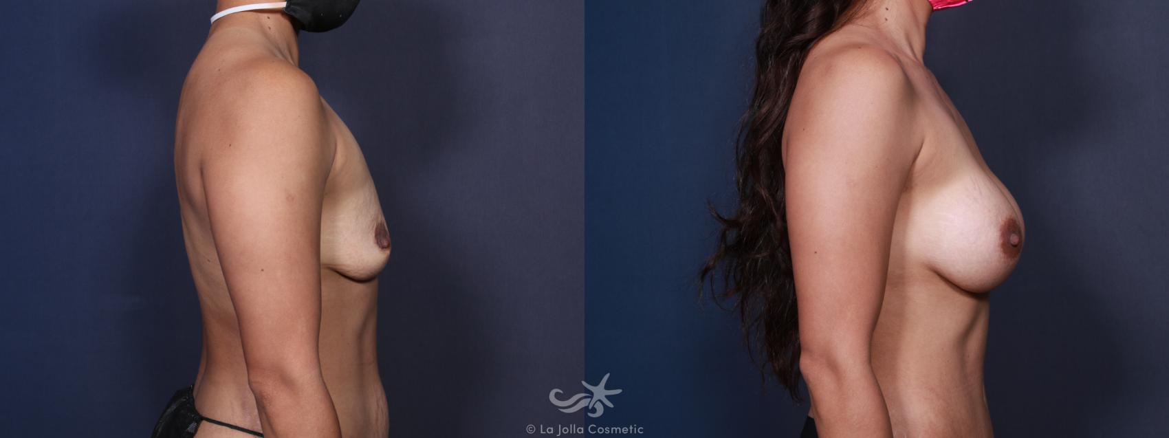 Before & After Breast Augmentation Result 96 Right Side View in San Diego, CA