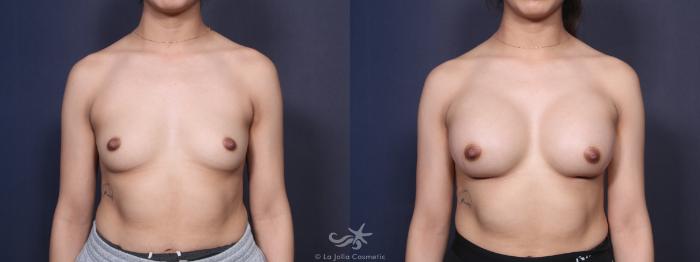 Before & After Breast Augmentation Result 97 Front View in San Diego, Carlsbad, CA
