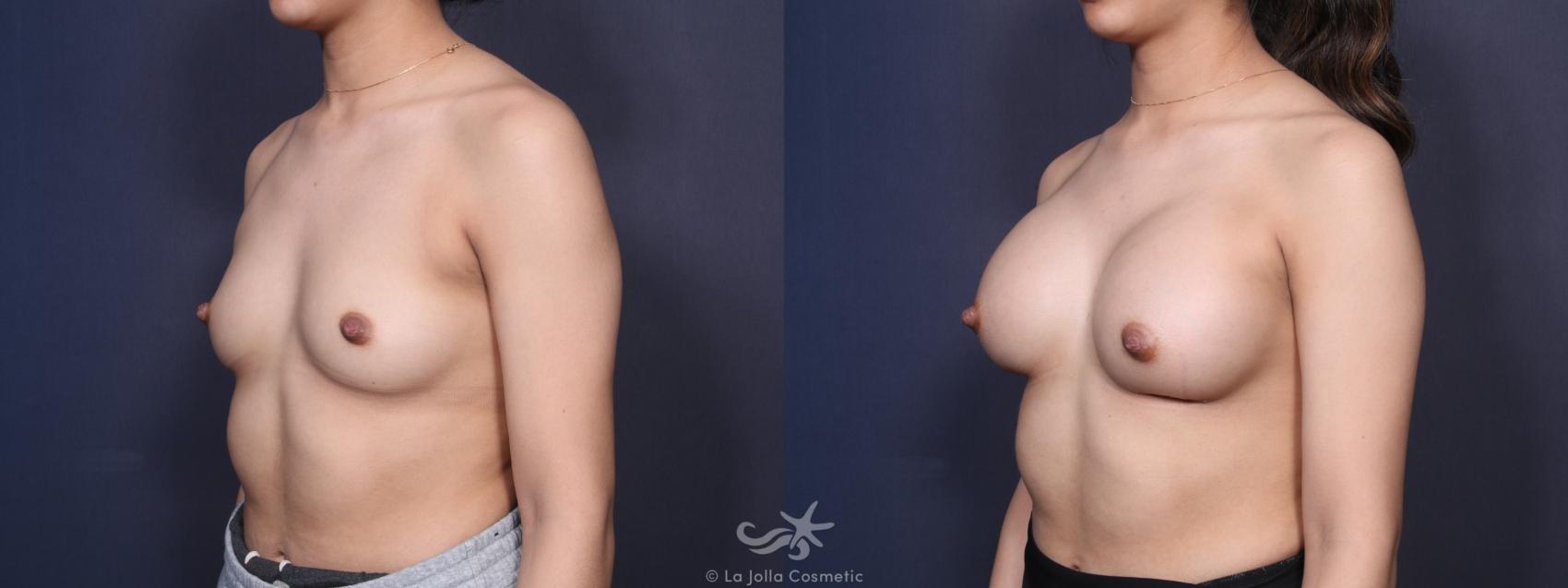 Before & After Breast Augmentation Result 97 Left Oblique View in San Diego, CA