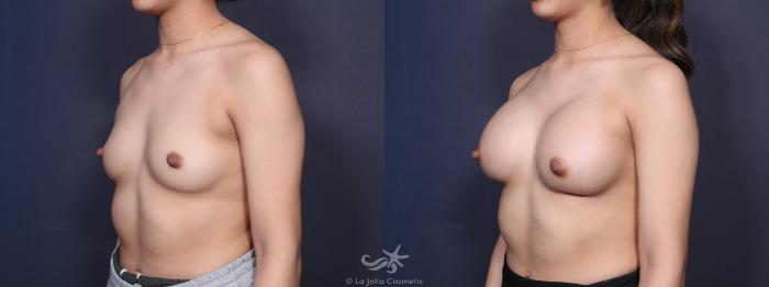 Before & After Breast Augmentation Result 97 Left Oblique View in San Diego, Carlsbad, CA