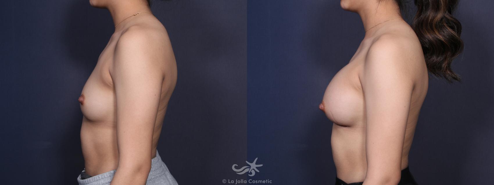 Before & After Breast Augmentation Result 97 Left Side View in San Diego, CA