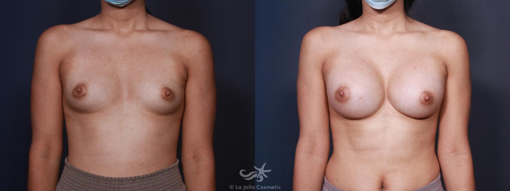 Before & After Breast Augmentation Result 98 Front View in San Diego, CA