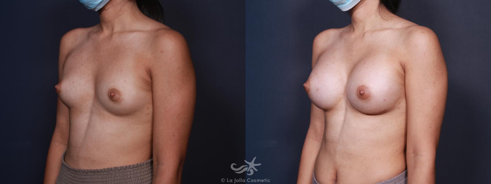 Before & After Breast Augmentation Result 98 Left Oblique View in San Diego, CA