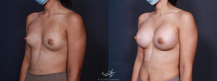 Before & After Breast Augmentation Result 98 Left Oblique View in San Diego, Carlsbad, CA