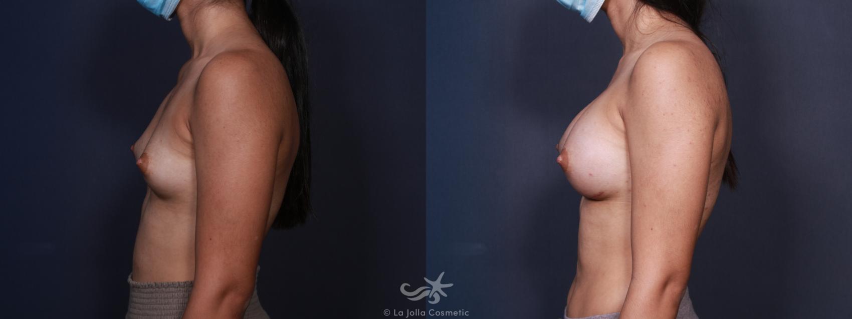 Before & After Breast Augmentation Result 98 Left Side View in San Diego, CA
