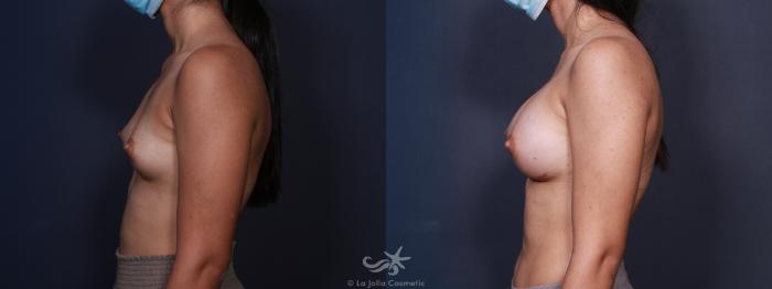 Before & After Breast Augmentation Result 98 Left Side View in San Diego, Carlsbad, CA