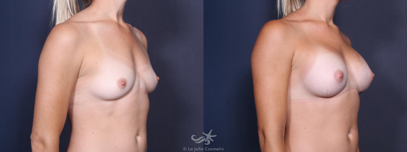 Before & After Breast Augmentation Result 99 Right Oblique View in San Diego, CA