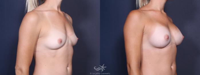 Before & After Breast Augmentation Result 99 Right Oblique View in San Diego, Carlsbad, CA