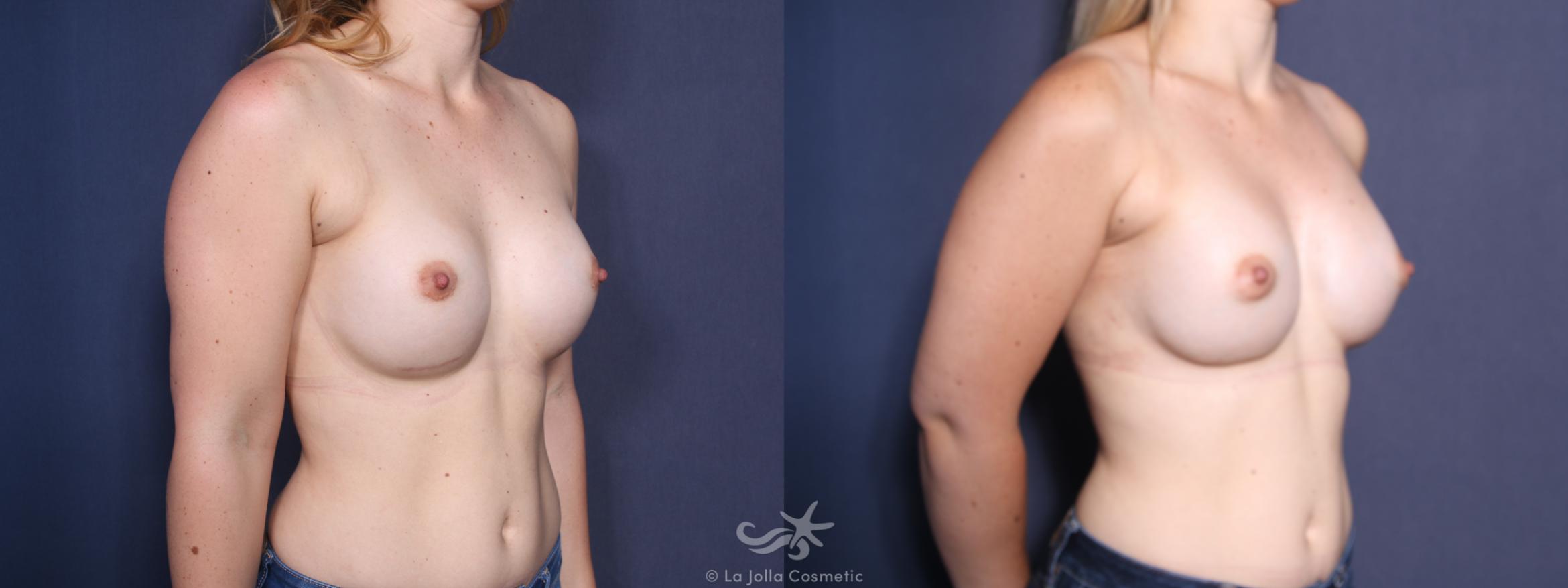 Before & After Breast Augmentation Revision Result 17 Right Oblique View in San Diego, CA
