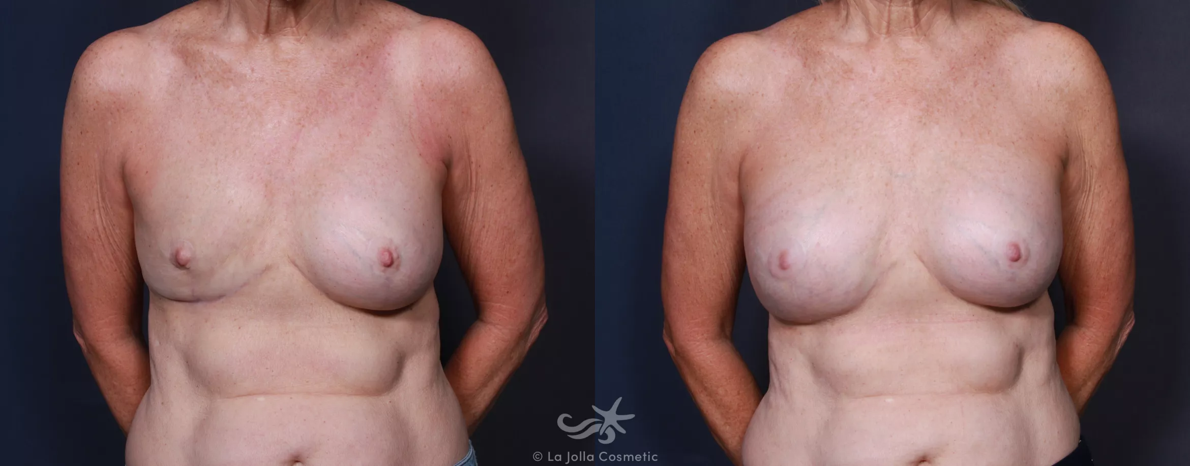 Before & After Breast Augmentation Revision Result 206 Front View in San Diego, CA