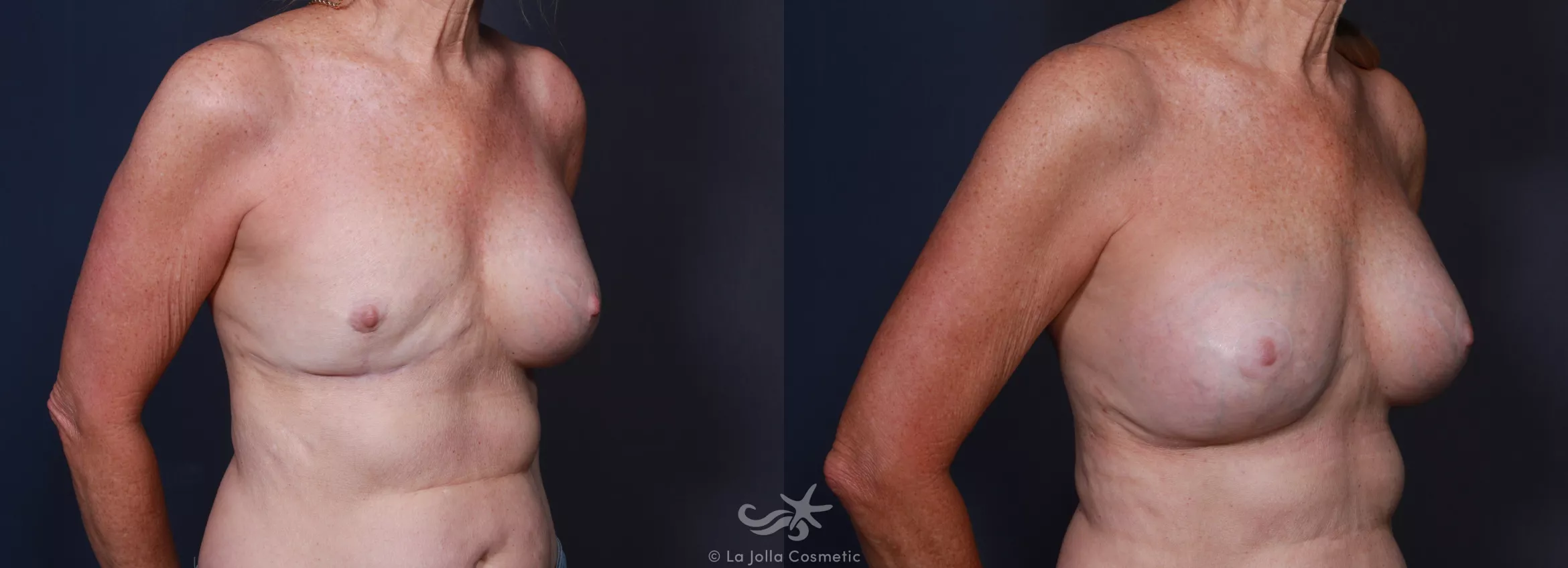 Before & After Breast Augmentation Revision Result 206 Right Oblique View in San Diego, CA
