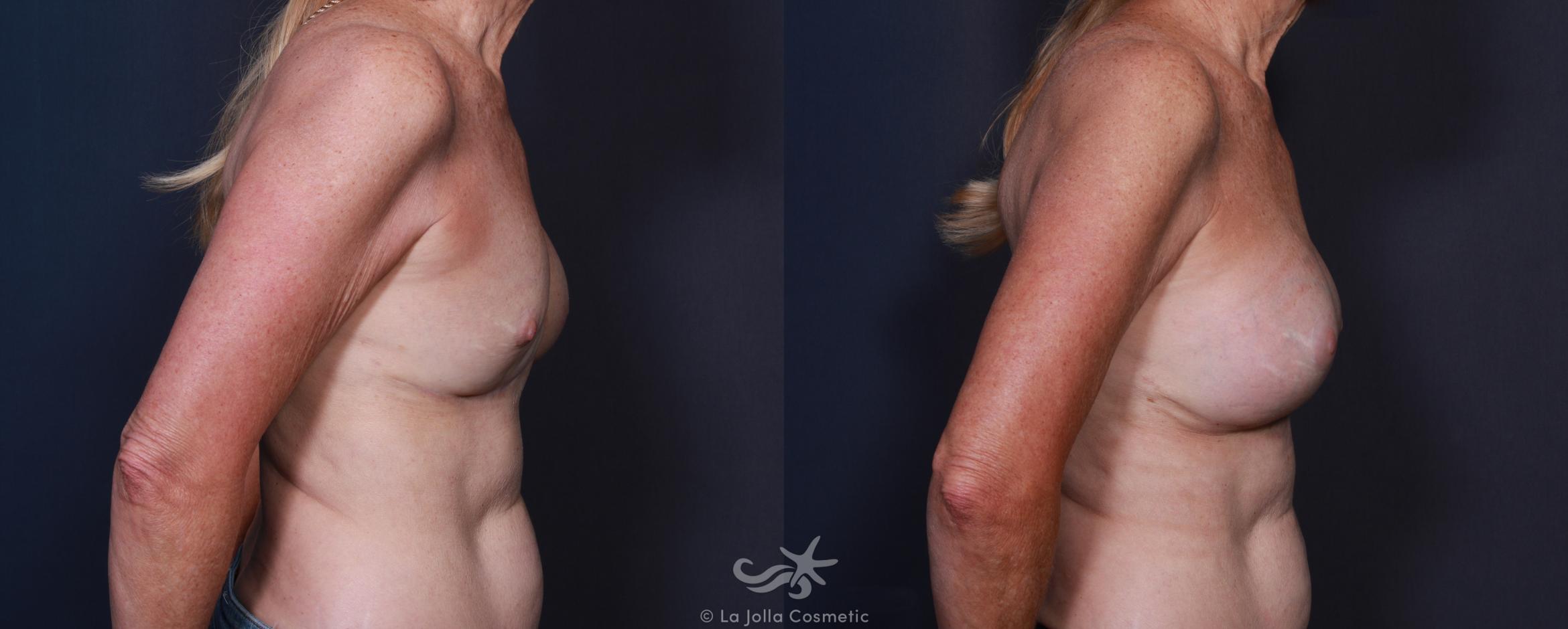 Before & After Breast Augmentation Revision Result 206 Right Side View in San Diego, CA