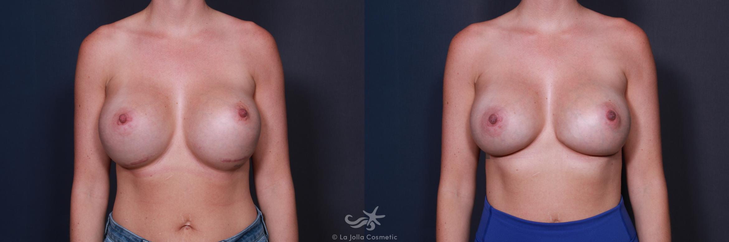 Before & After Breast Augmentation Revision Result 207 Front View in San Diego, CA