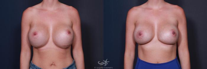 Before & After Breast Augmentation Revision Result 207 Front View in San Diego, Carlsbad, CA