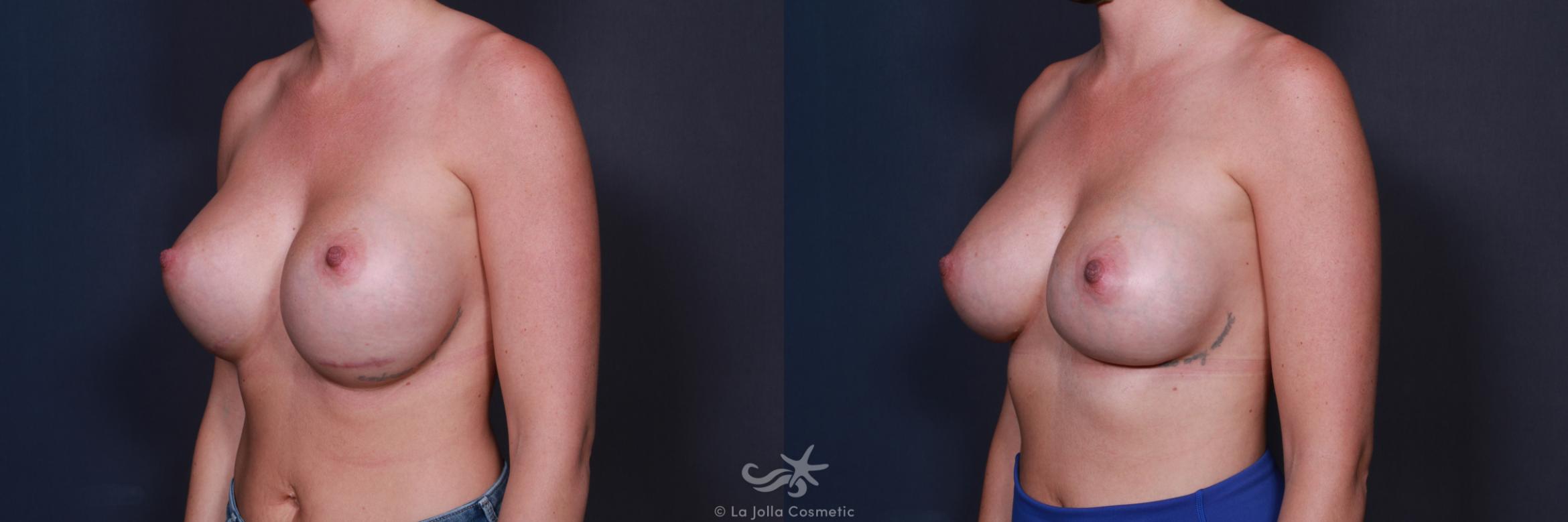 Before & After Breast Augmentation Revision Result 207 Left Oblique View in San Diego, CA
